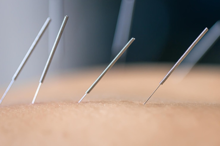 Dry Needling