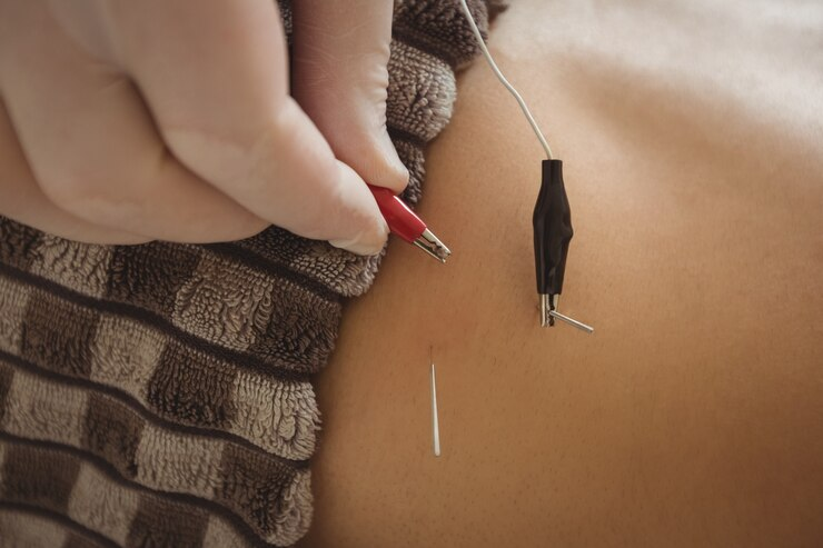 Dry Needling